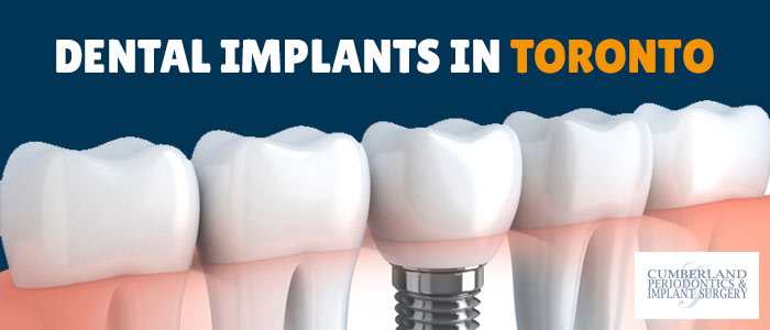 Dental Implants in Toronto