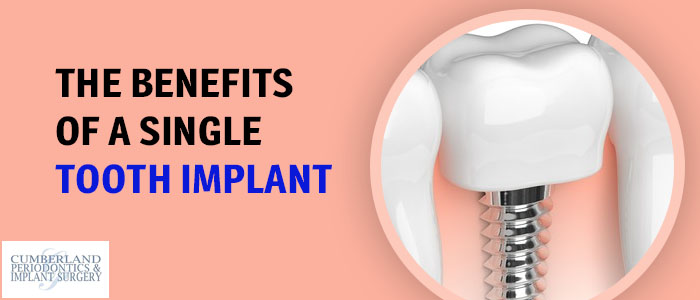 Single Tooth Implant