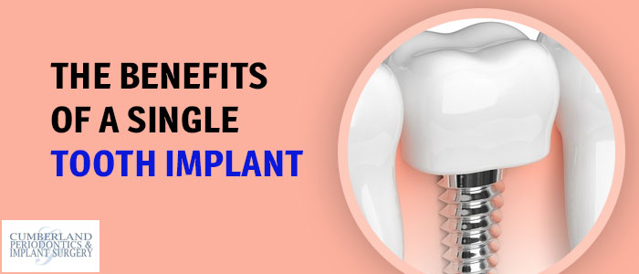 Single Tooth Implant