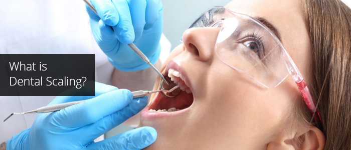 What is Dental Scaling