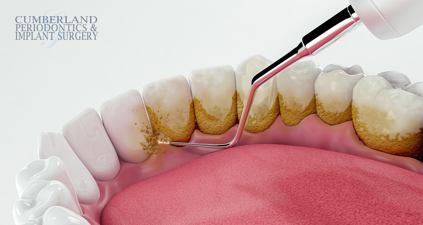 Periodontal Flap Procedure 101-What Periodontics in Toronto Can Do for You