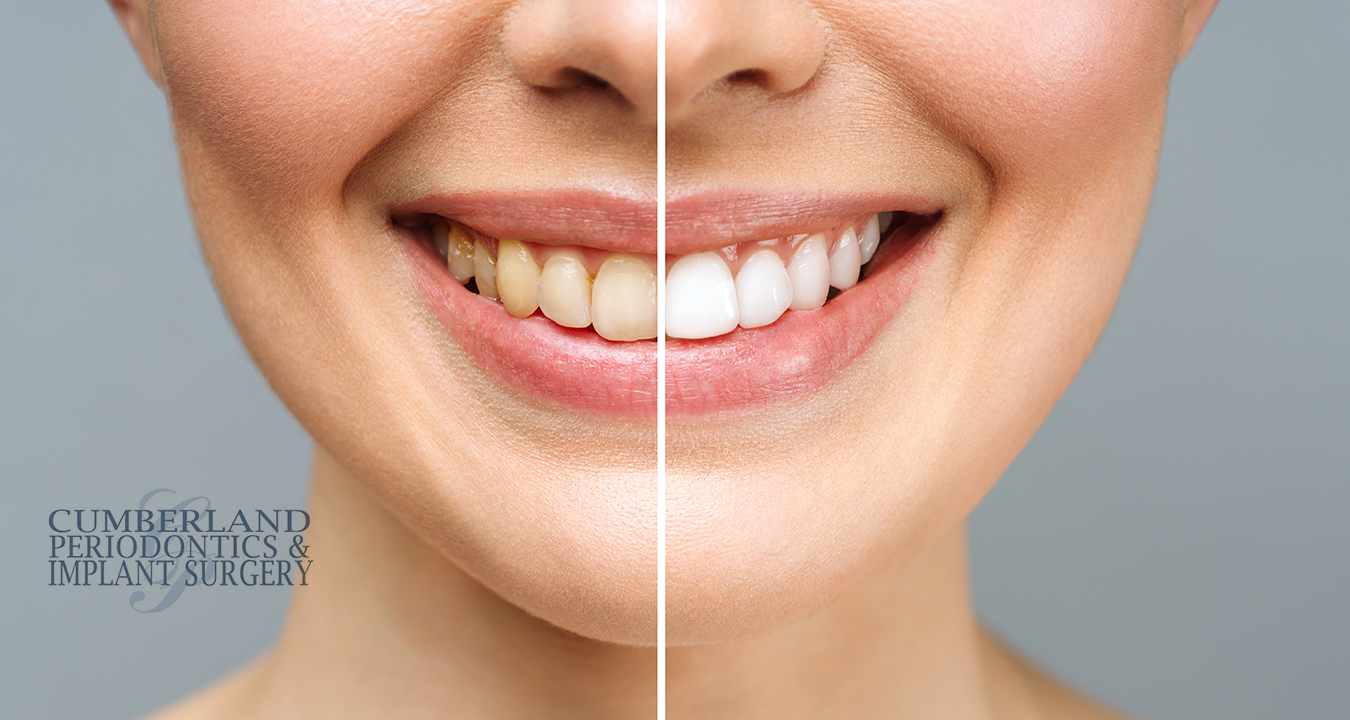 DIY Dental Care Can Home Remedies Replace Professional Scaling