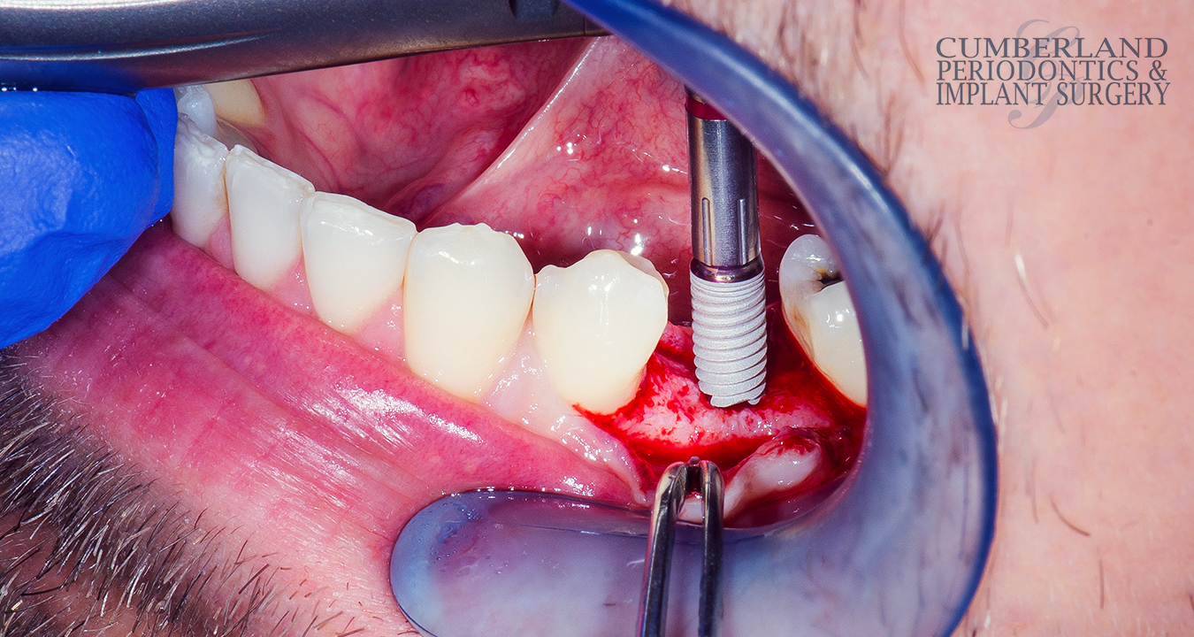 How-To-Find-Out-If-You-Can-Receive-Periodontal-Grafts-in-Toronto