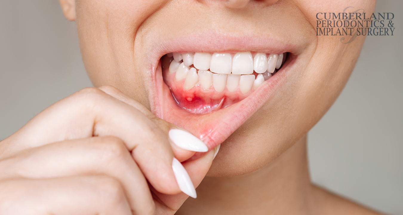 What-Are-the-Long-Term-Risks-of-Not-Treating-Gum-Disease