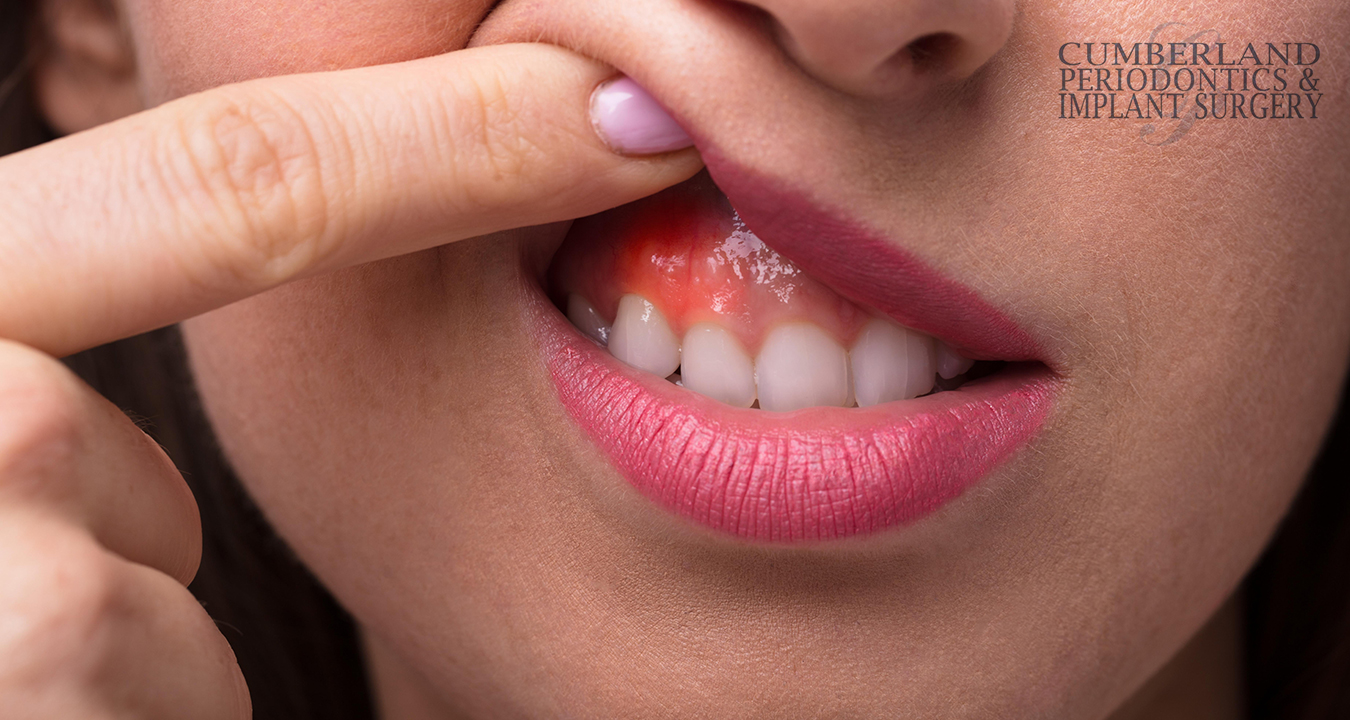 When-Gum-Problems-Go-Deeper-Than-the-Surface